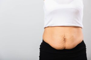 Ways on How to Tighten Loose Skin After Weight Loss
