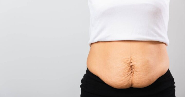 Ways on How to Tighten Loose Skin After Weight Loss